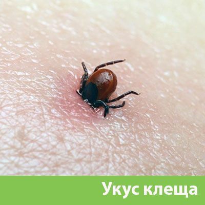 Укус клеща в Балашихе